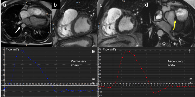 RAME Journal (@radiolmed) on Twitter photo Editor's Pick: CARDIAC RADIOLOGY
Appropriate use criteria for cardiovascular MRI(CMR): SIC—SIRM position paper part 1 (ischemic and congenital heart diseases, cardio-oncology, cardiac masses and heart transplant)
link.springer.com/article/10.100…
#radiology <a href="/ClinMedJournals/">Springer Medicine</a> <a href="/GPontone1973/">Gianluca Pontone</a> Editor's Pick: CARDIAC RADIOLOGY
Appropriate use criteria for cardiovascular MRI(CMR): SIC—SIRM position paper part 1 (ischemic and congenital heart diseases, cardio-oncology, cardiac masses and heart transplant)
link.springer.com/article/10.100…
#radiology <a href="/ClinMedJournals/">Springer Medicine</a> <a href="/GPontone1973/">Gianluca Pontone</a>