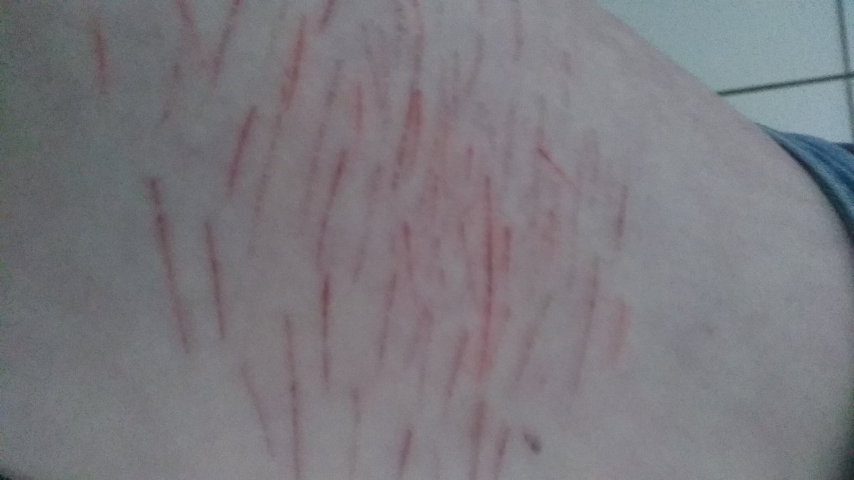 Huata20's tweet photo. Warning! self harm/cuts
.
.
.
 .
.
.
.
.
.
.
.
.

.
.
.

.
.
.
. https://t.co/NCVHBDh00M