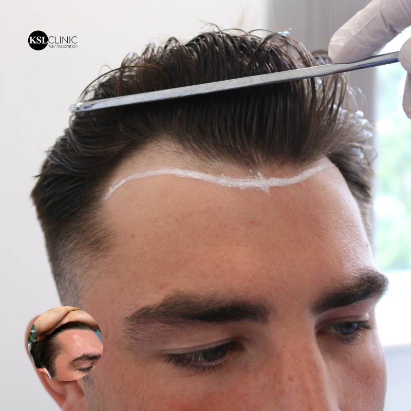 KSL_Clinics's tweet photo. Always a pleasure to have Jack Fincham in for a PRP treatment & review.
Jack’s hairline is coming along nicely 9 months post procedure.
#KSLClinic #JackFincham #JackFinchamHairTransplant #LoveIsland #HairTransplant #FUE #FUEProcedure #DrMatee https://t.co/p1bpXl9YBl