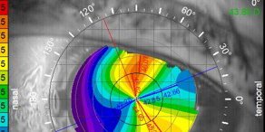 Join us on March 11 at 8:00 PM ET for the 2021 update on cataract. Topics include: choosing premium lenses, postop fixes, and drop-less and reduced drop cataract surgery.

ow.ly/XYIW50DOl3w