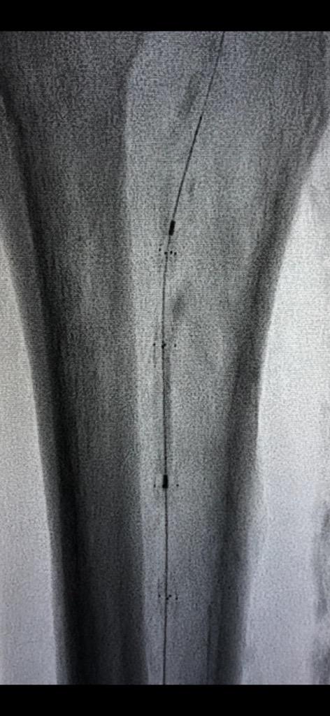 JayHeimsoth's tweet photo. Congratulations to Dr. Zulfiqar Cheema for the first BTK Tack deployed at HCA Clear Lake Regional Medical Center. Kudos to Orlando Gamero for his dedicated efforts in support. #dissectionsmatter #tackitup #philips #SCTO #padawareness https://t.co/AK1lR5v79o