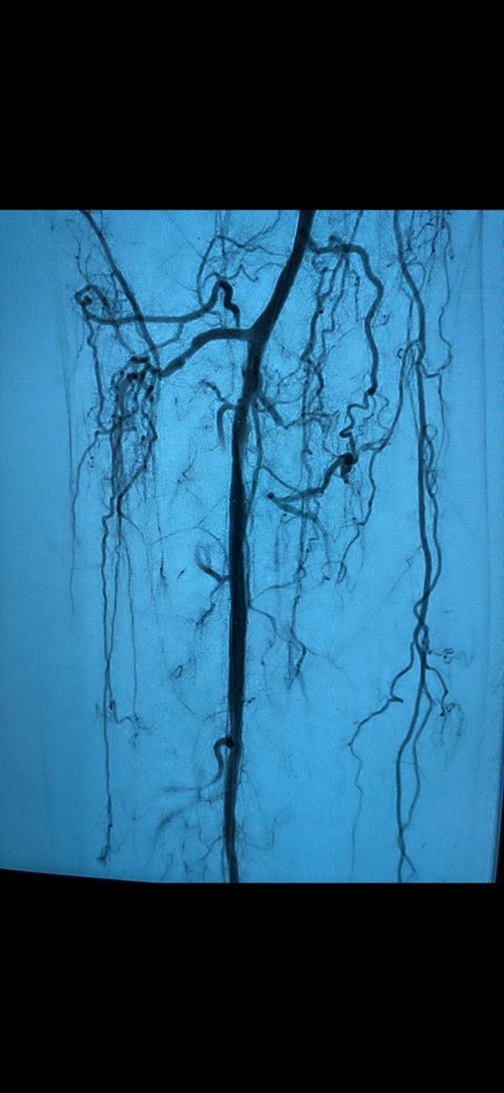 JayHeimsoth's tweet photo. Congratulations to Dr. Zulfiqar Cheema for the first BTK Tack deployed at HCA Clear Lake Regional Medical Center. Kudos to Orlando Gamero for his dedicated efforts in support. #dissectionsmatter #tackitup #philips #SCTO #padawareness https://t.co/AK1lR5v79o