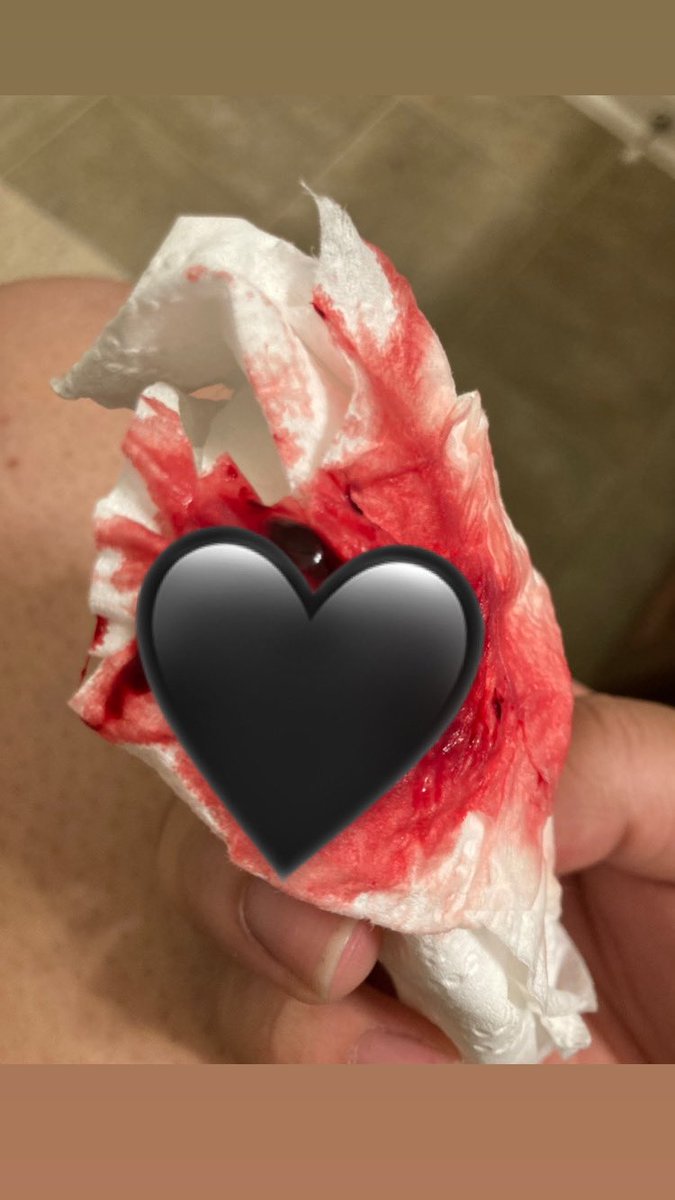 thingsyouwanna3's tweet photo. Blood clots are no fun https://t.co/iAVnUc2LMd               #nsfw #nsw #onlyfansbabe #onlyfans #subscribe #menstruation #thingsyouwannaknow #follow #onlyfanslinkinbio https://t.co/gVYMLceP9f