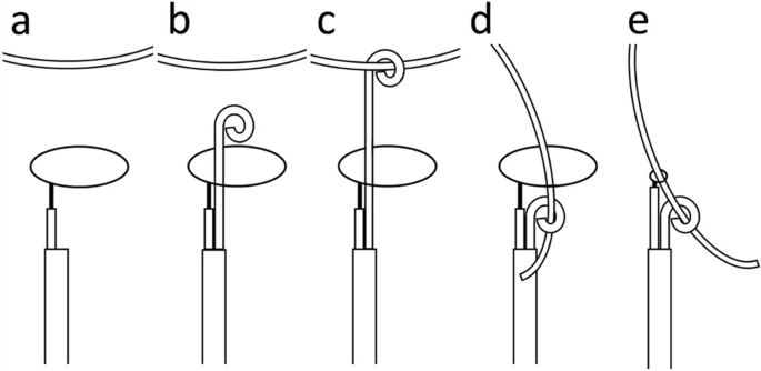 “Pigtail through snare” technique: an easy and fast way to retrieve a catheter fragment with inaccessible ends | cvirendovasc.springeropen.com/articles/10.11…
#PigtailCatheter #catheter #IRad