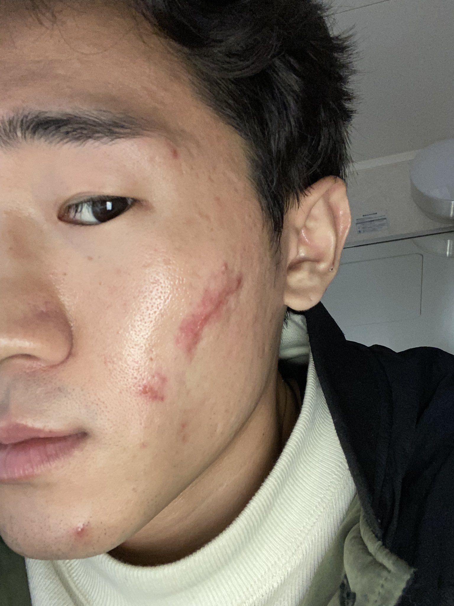 キヨキヨ セルフ美容家 クレーター肌治療をセルフではじめてから 初の皮膚科だったので緊張 顔を見るなり ニキビの跡をほじくったんだね と すぐバレました これからもっと顔に傷つけるかもしれないけど 通わさせていただきます まだまだ 治療