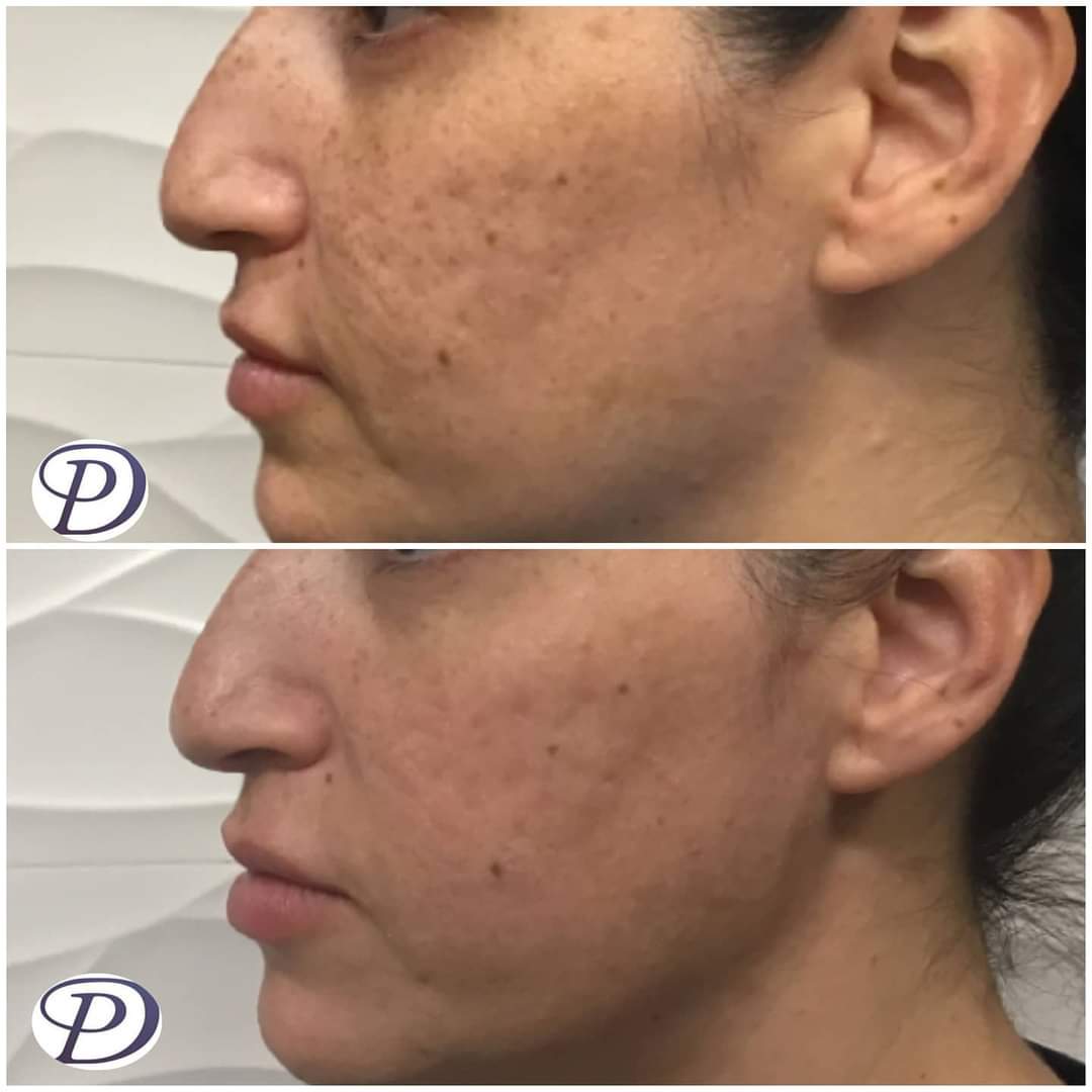 angicakes13's tweet photo. Annoyed by brown or red spots? This is 4 weeks post- treatment with the Lumecca IPL laser, by @inmodeaesthetics . Take care of those pesky sun/age spots and have a more flawless complexion before @brittanydenue_dps @lisa.rn.dps @cerissafamehayes https://t.co/GoOqcRT7gg