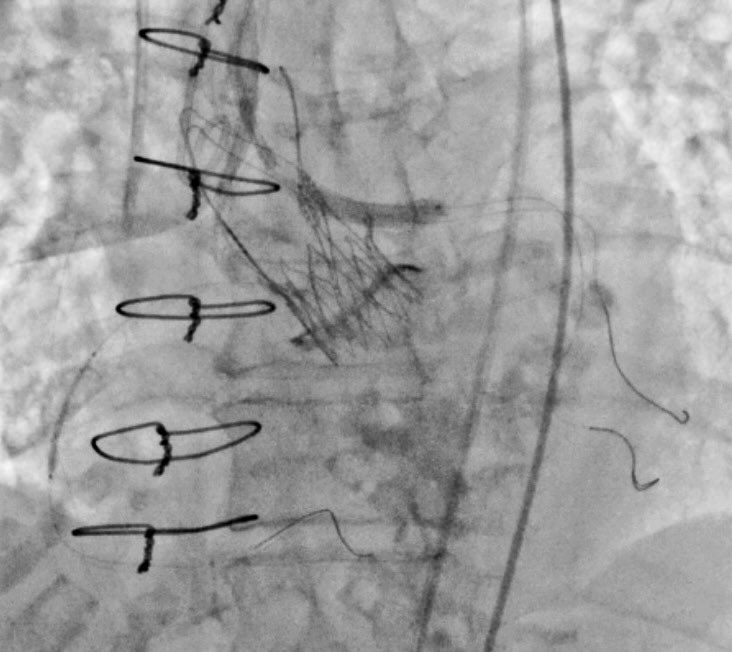 Mitroflow 21 valve-in-valve TAVI with Acurate Neo S. 
- Coronary protection x 2. 
- Cracking with Atlas gold 20mm  &gt;&gt;&gt;mean gradient 6mmHg vs 30mmHg. 
- Left Main PCI with ‘chimney technique’
<a href="/deharo_pierre/">pierredeharo</a> <a href="/CuissetDr/">DrThomasCuisset</a> <a href="/aphm_actu/">AP-HM - Hôpitaux Universitaires de Marseille</a>