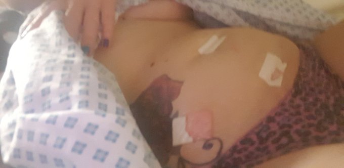 Had key hole surgery remove baby gutted but glad back my jeans I be back next week x https://t.co/cK<a href="/tag/sex"class="tags"><span>#sex</span></a><a href="/tag/videos"class="tags"><span>#videos</span></a><a href="/tag/content"class="tags"><span>#content</span></a><a href="/tag/contentcreator"class="tags"><span>#contentcreator</span></a>