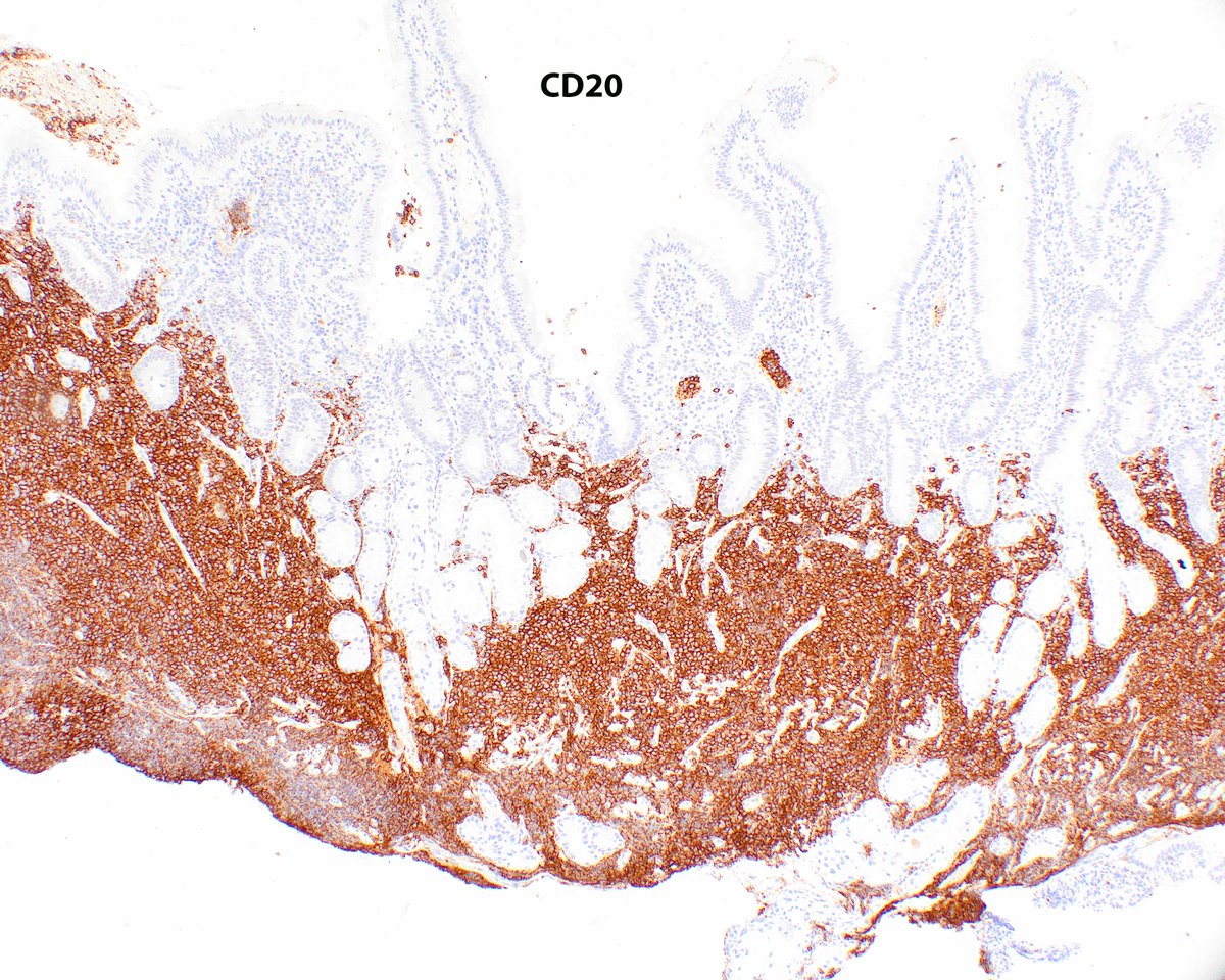 science_press's tweet photo. Blastoid variant of mantle zone lymphoma arising in an unusual location (duodenum).  Eve Crane has done a beautiful job on our upcoming Survival guide to hematopathology. Pre-order yours at  https://t.co/11aBMJG2Yg https://t.co/ol9DkgDbtN