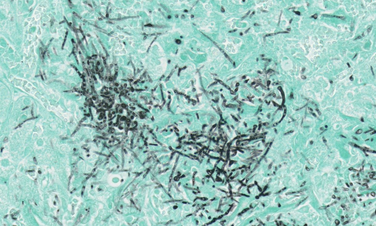 GMS staining of a fungal infection in the kidney, staining by <a href="/lcawight/">lucy wight</a> and imaged by facility manager <a href="/KevMack62/">Kevin Mackenzie</a>  on our <a href="/zeiss_micro/">ZEISS Microscopy</a> AxioScan Z1 slide scanner #microscopy #histology #kidney