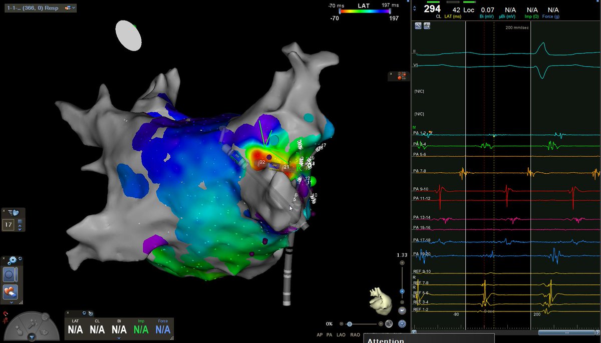 Finn Akerstrom Afl In Patienten With Previous Pvi And Extensive Ant Roof And Septal Lvz Not Ablated Below Initial Lat Map Epeeps Answer Honestly Who Would Have Jumped To Ablate