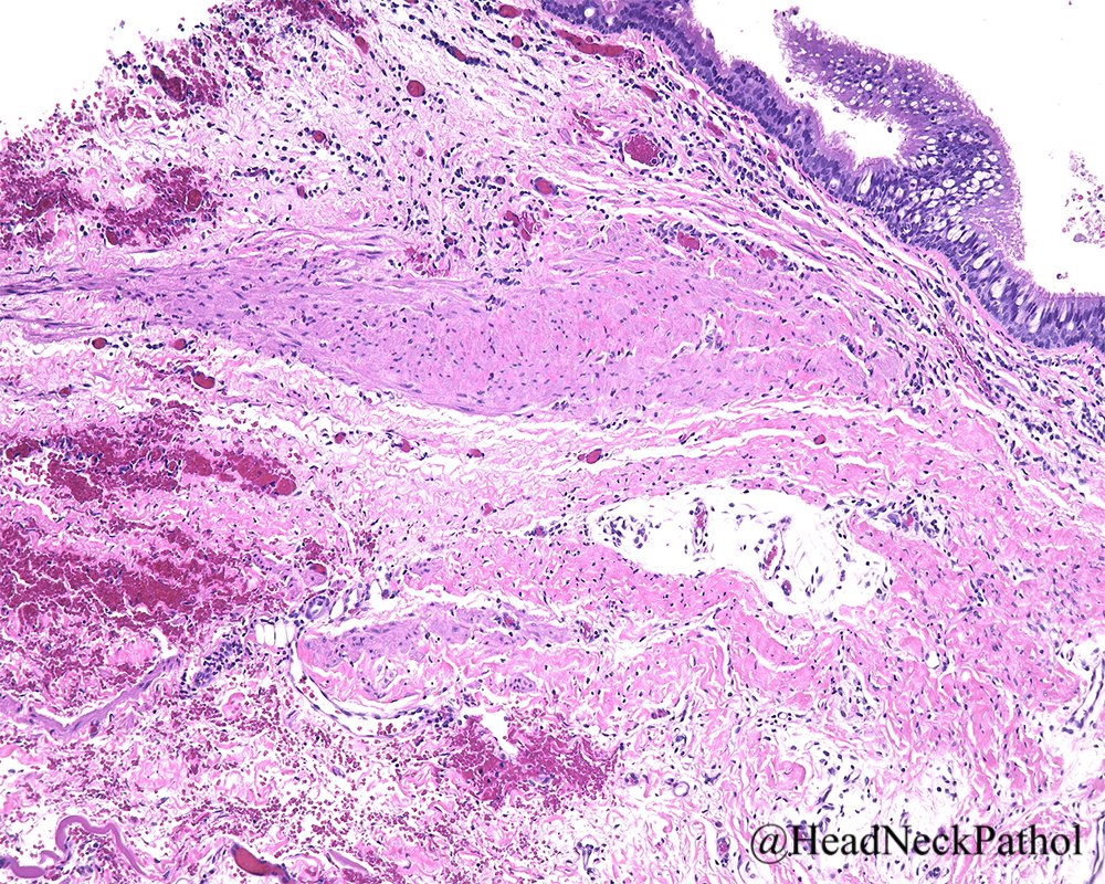 A Bronchogenic Cyst Masquerading as a Tongue Mass
By Zahra Aldawood, David J. Moyer &amp; Sook-Bin Woo 
rdcu.be/cf9H0
#HeadNeckPathol #HNPJ #HeadandNeckPath #Pathology #ENTPath #PathologyTweet