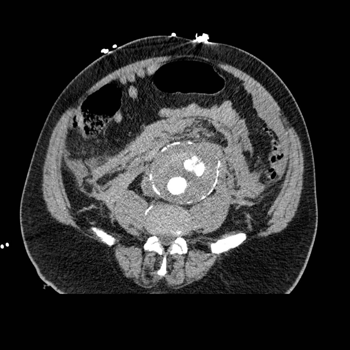 raimcsantos's tweet photo. Impressive ruptured aneurysm AAA Hemorrhagic shock and open surgery. Hyperattenuating crescent sign, split eggshell sign. #rupturedAAA #rupturedaneurysm #aorta #aortaaneurysm #aortaEd @ThinkAorta @farkomd @DVervoort94 @AWBeckMD @cfbechara @FotehMazinMD @GustavoOderich https://t.co/N0DRvm52xZ