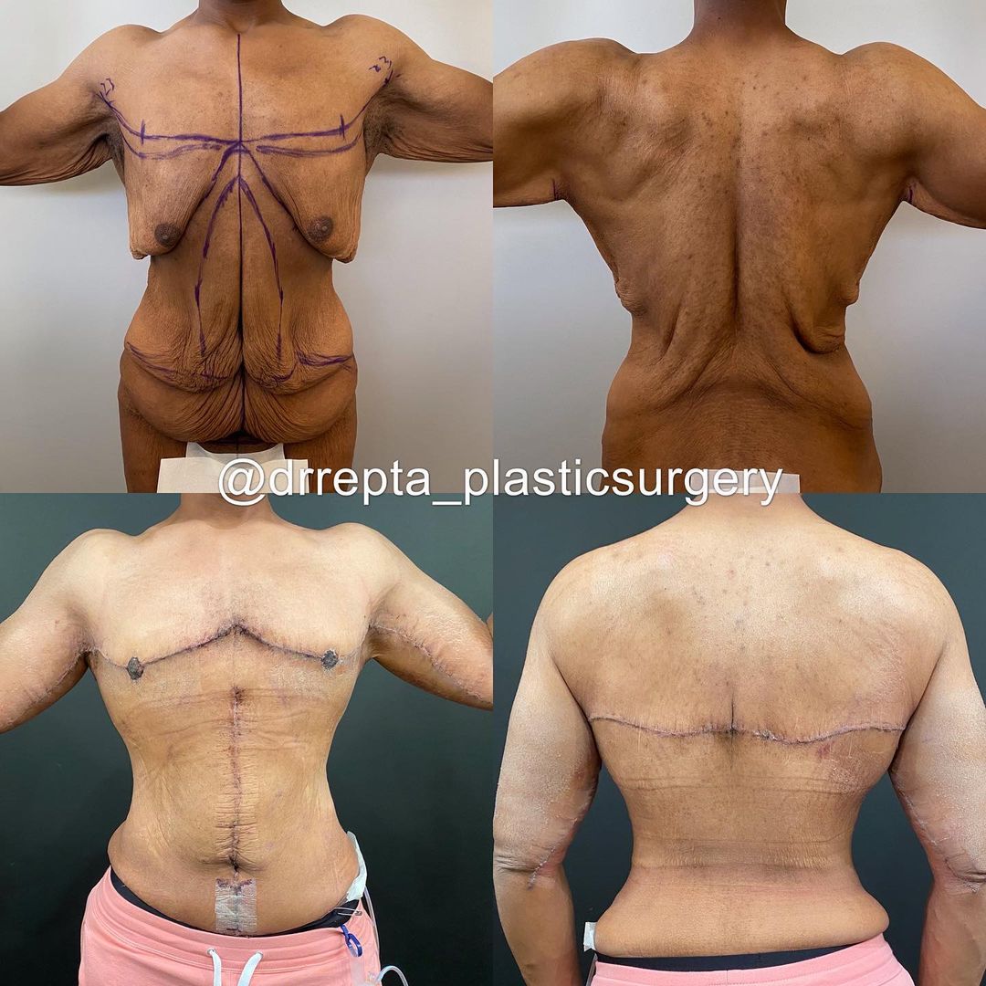 Dr. Remus Repta on X: After losing over 200lbs, this patient was left with  big folds of loose skin. After lots of planning, we performed a fleur-de-lis  tummy tuck, back lift, extended