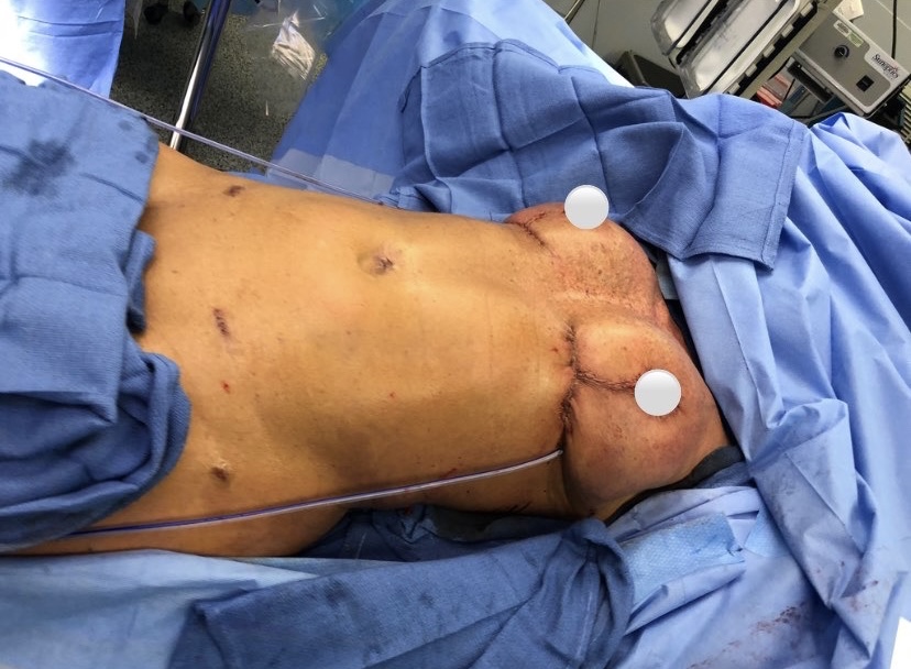 DiepFlapBreast's tweet photo. Suffering from #BreastImplantIllness, this patient came to PRMA for #ExplantSurgery. Removing the implants dramatically decreased her breast size, but with additional #FatGrafting the patients new desired breast size and symmetry were achieved! https://t.co/ztNTCjOAjM