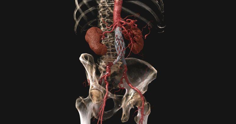 CanonMedical's tweet photo. What an incredible view of an AAA with a stent and vascular graft within the aortic bifurcation. This is #GlobalIllumination, the new standard in advanced visualization. #MadePossible

Visit https://t.co/9rzOPbLdM1 to find out more.
#advancedvisualisation #photorealistic https://t.co/ePaT7I1LiC