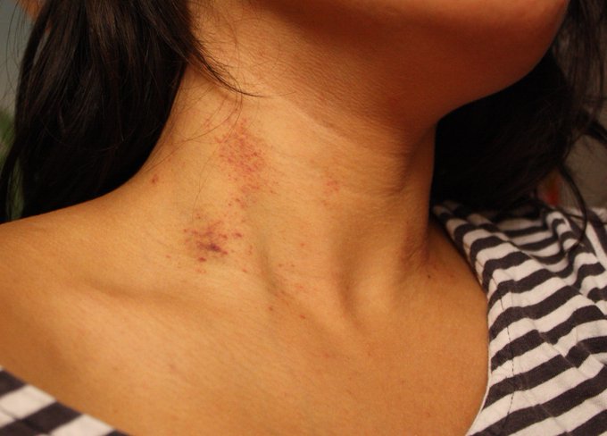 I'm organizing my old files, and found where I used to like document my hickies in college. https://t<a href="/tag/apclips"class="tags"><span>#apclips</span></a><a href="/tag/aplove"class="tags"><span>#aplove</span></a>