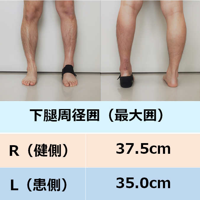 アキレス腱 断裂 装具 左 術後 保存療法 レディース 女性 アキレス腱 断裂 装具 左 術後 保存療法 レディース 女性