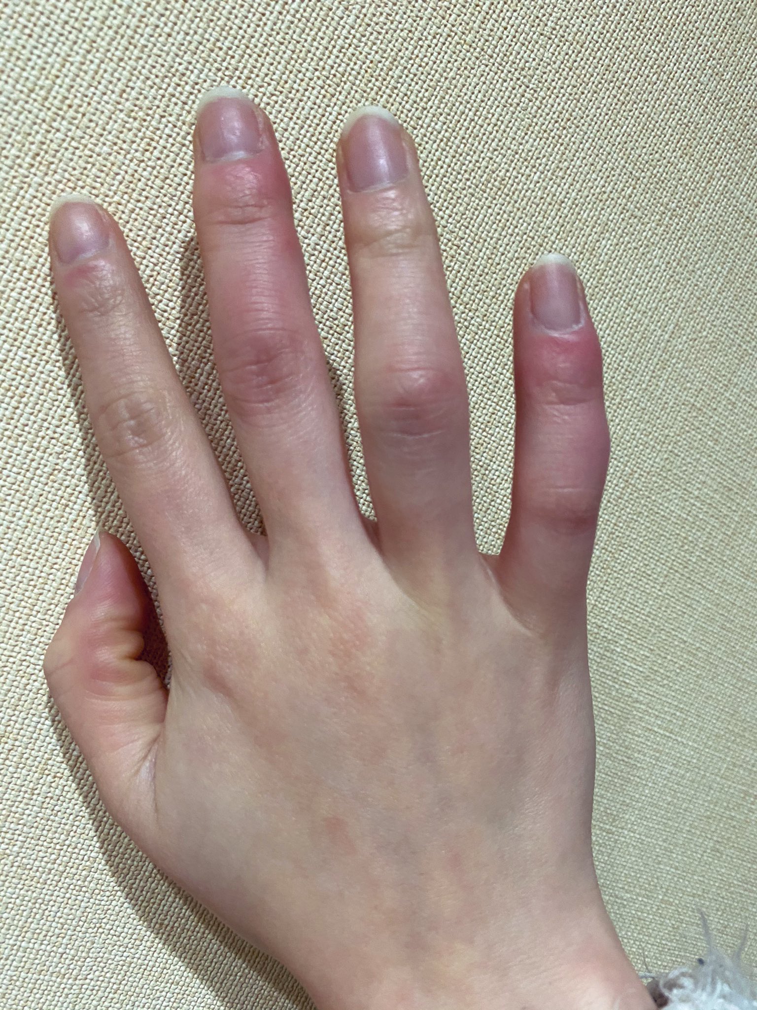 市原 希望 いち En Twitter 汚い手注意 こんなに酷いしもやけなったの久しぶりだすごい辛い痛痒い 赤くないけど腫れてきたタイミングでこれしもやけかー って思って皮膚科行ったのにしもやけは赤くなるんですって言った医者許さない 赤くなったぞこら