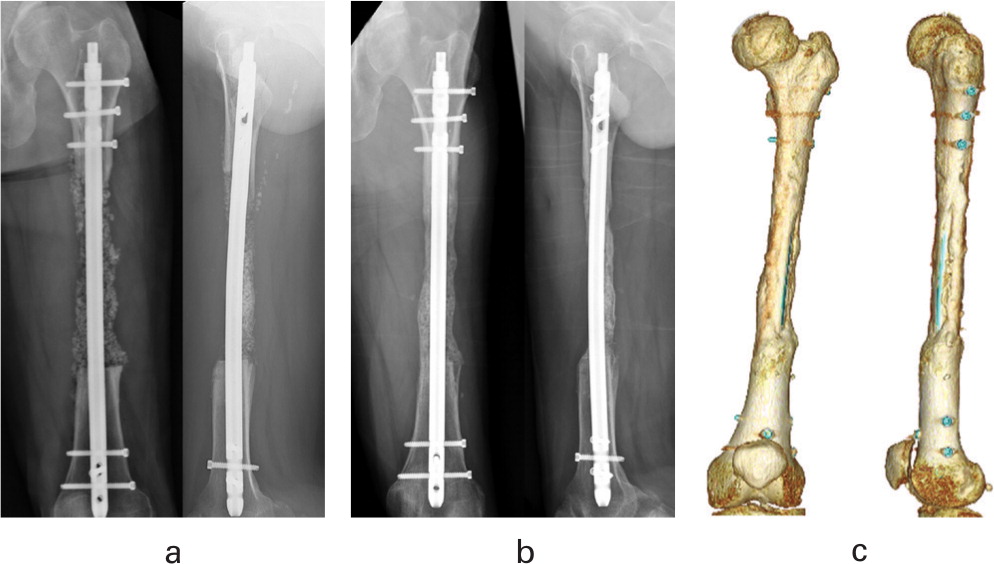 Large bone defects are caused by #trauma, infection, and tumour. New study concludes induced membrane technique using beta-tricalcium phosphate provided satisfactory clinical & radiological outcomes for segmental bone defects in the lower limbs https://t.co/K8a4k808Xt #ortho https://t.co/ROYjIRyMj4