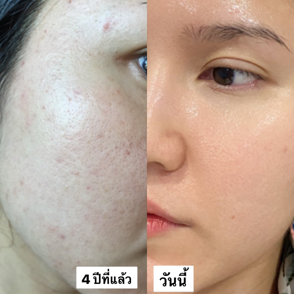 thedocterswife's tweet photo. #สิว เป็นสิ่งที่เป็นได้ก็หายได้ key คือ ต้องมีวินัย อดทนและต้องใช้เวลา 

Basic skincare ที่ควรมีคือ
1. Moist ที่เหมาะกับผิว (ต้องหาให้เจอ)
2. กันแดด 2 ข้อนิ้วทุกวันแม้อยู่บ้าน
3. Double cleanse ทุกวัน

หายแน่นอน เป็นกำลังใจให้ทุกคน

#เมียหมอขอรีวิว https://t.co/D2pSeAY7de