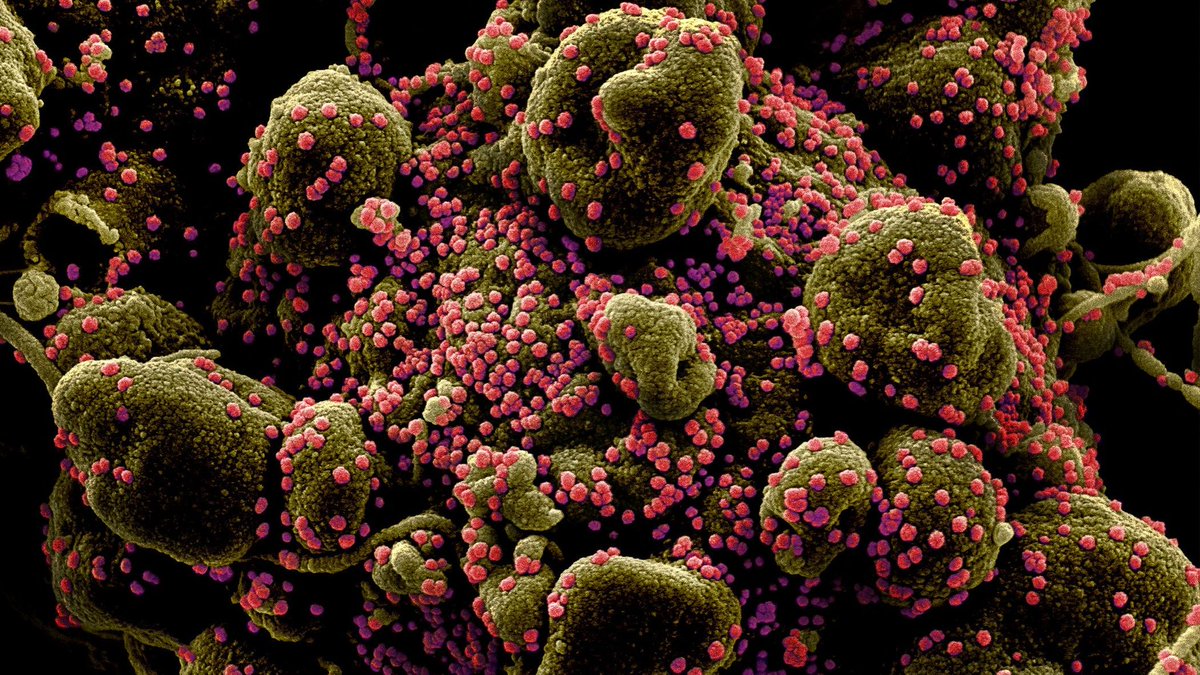CaraSantaMaria's tweet photo. Coronavirus variant in Brazil infected many who had already recovered from Covid-19...

#CoronavirusVariants #COVID19 #BrazilVariant #B1 #VirusMutations 

https://t.co/FZ3gNhpEyy https://t.co/HhvQcBGMUc
