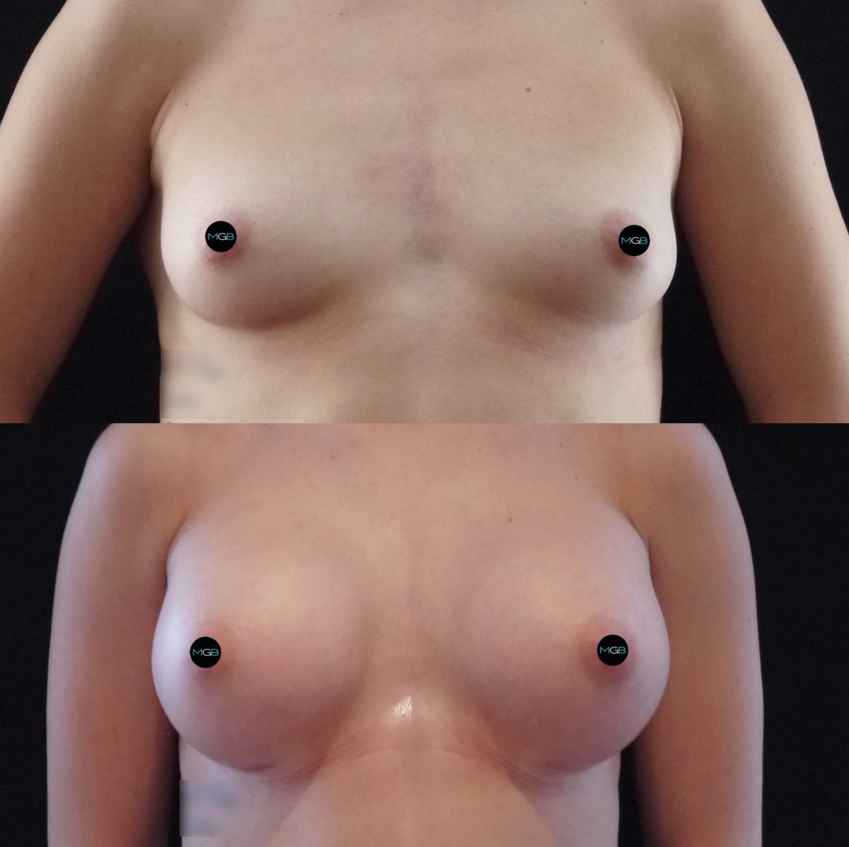 MrMilesBerry's tweet photo. Breast Augmentation Surgery - Please Call 020 7486 6778 for enquiries

https://t.co/FrDico1ucZ

#beforeandafterbreastsurgery #beforeaftersurgery #breastsurgeryexpert https://t.co/J2QZBDsBQK
