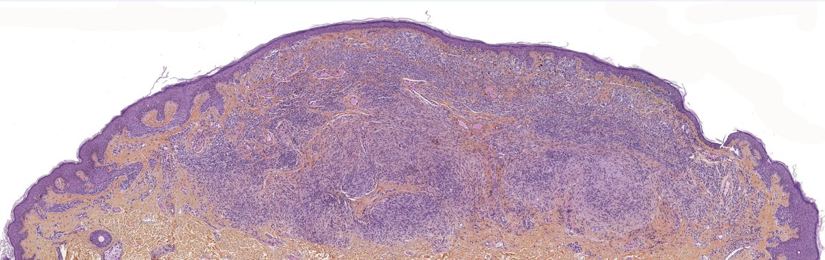 Here is a preview of the next case of melanocytic tumor I'll be showcasing on our department's YT channel (Centre Léon Bérard - Pathologie). Answer will come with video
#dermpath #pathology #Melanoma