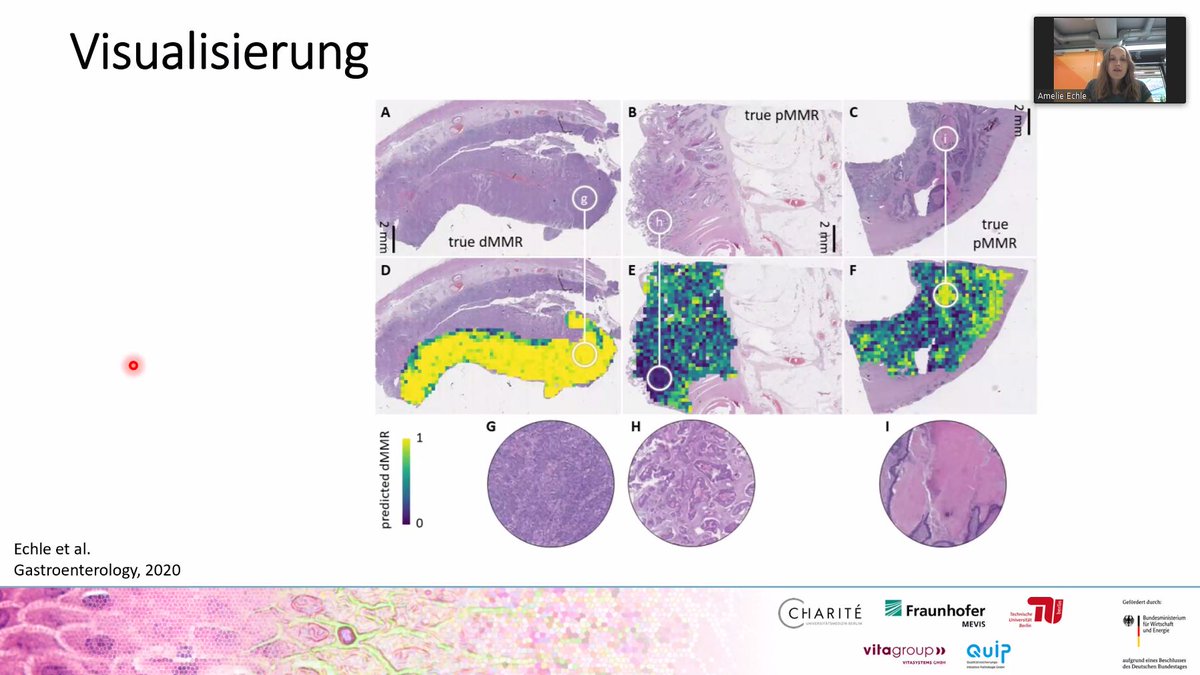 TheEMPAIA's tweet photo. #EMPAIAAcademy continues with speaker Amelie Echle (@a_echle) from @UniklinikAachen @RWTH: “Use cases and Examples of #AI Applications in #Pathology” #deeplearning, #pathomics, #mutationdetection, #GANs #syntheticdata https://t.co/KzjYcwrRmf
