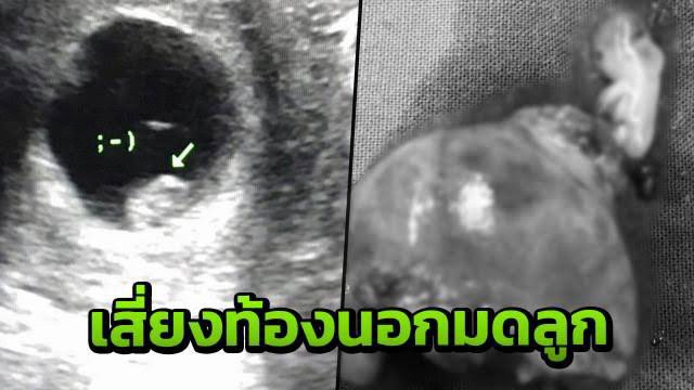 Underyourbedd's tweet photo. เตงเคยมีความคิดว่าทำสดไปก่อน เดี๋ยวค่อยกิน ‘ยาคุมฉุกเฉิน’ ก็ได้ บ้างหรือเปล่า

หยุดเดี๋ยวนี้ หยุดทันที

เตง ยาคุมฉุกเฉินมันเป็นฮอร์โมนอย่างแรง กินบ่อยๆไม่ดี แถมถ้าเกิดคุมไม่สำเร็จก็เสี่ยงท้องนอกมดลูกอีก ประสิทธิภาพก็ยังไม่ดีเท่ายาคุมทั่วไปด้วย

ยืดอกพกถุงเลิกสด ลดโรค ลดพลาดท้อง https://t.co/h07mTZCDmL