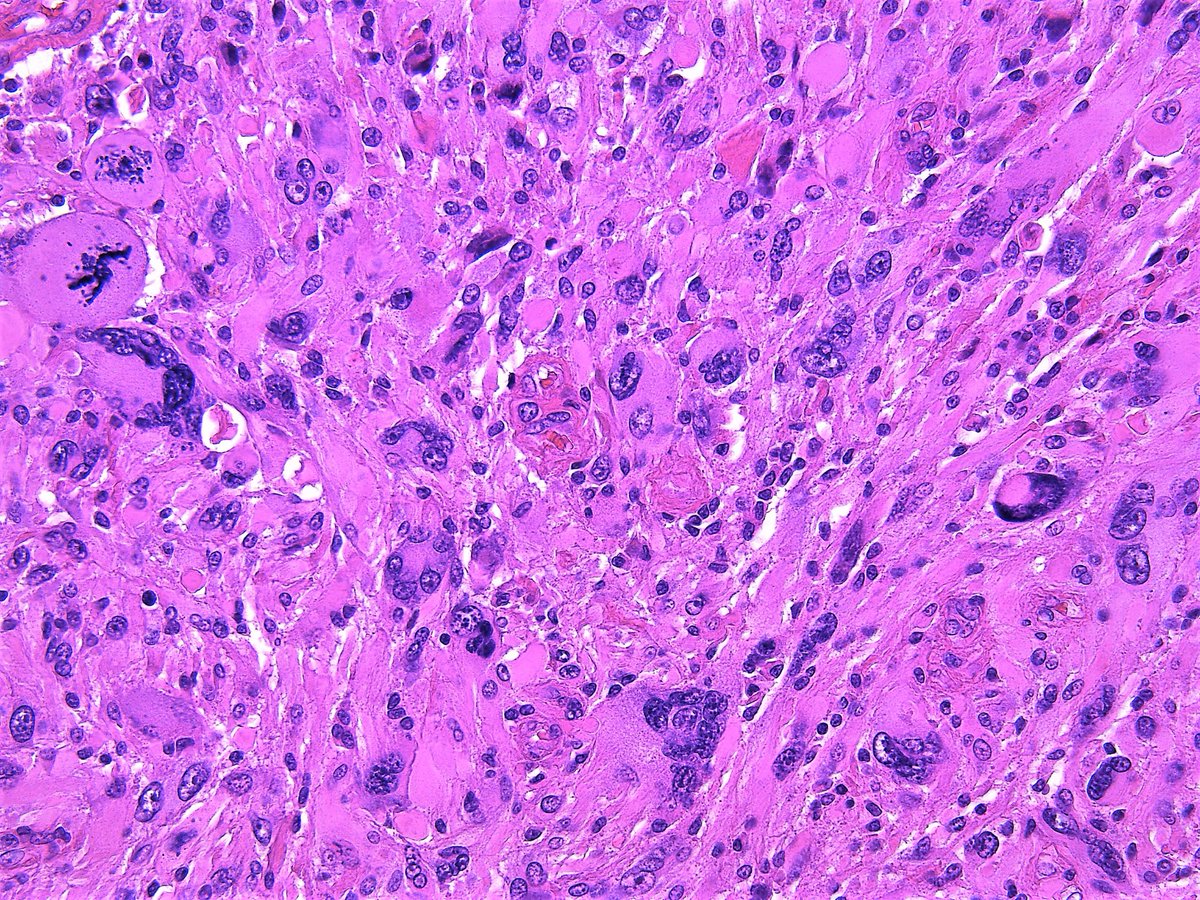 Pathology WalkerAuto Tweet Bot on Twitter "Giant cell glioblastoma