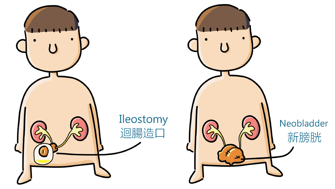 [#CUHKUrology] 🕵️🩺Radical cystectomy is a major surgery aiming to remove all bladder cancer cells from your body. Creation of an ileal conduit or neobladder reconstruction would be required to divert the urine out from your body. 
Details: bit.ly/2NPD8WI