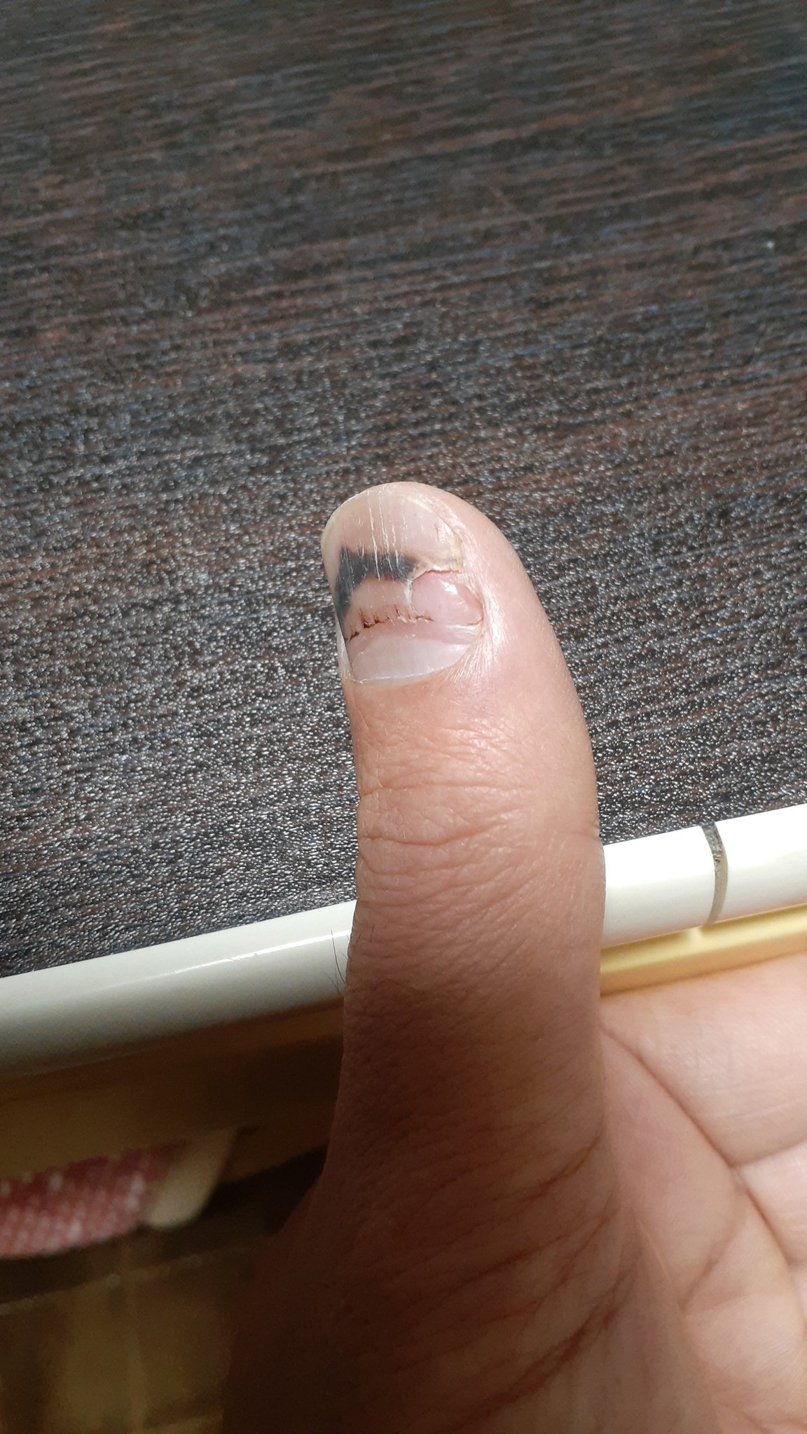 真 Makoto 蒼い矮星 肺炎と気管支喘息 内出血の辺りの端から爪が剥がれかけてきて軍手に引っかかるからそっと爪切りで不要なところを切ってみた 見た目には痛そうやけど痛くはないんですよ 今日もキラメこうぜ T Co 4ens8ckup3 Twitter