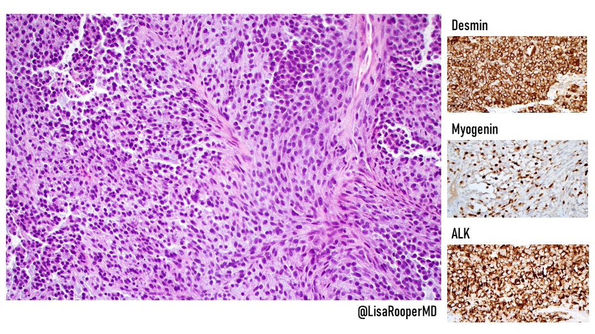 Intraosseous rhabdomyosarcoma with EWSR1/FUS-TFCP2 fusions: frequently arise in craniofacial bones, plump spindled and epithelioid cells with eosinophilic cytoplasm and monotonous oval nuclei, desmin+/myogenin+/CK+/ALK+. PMID: 33382123 #ENTPath #BSTPath #IHCPath