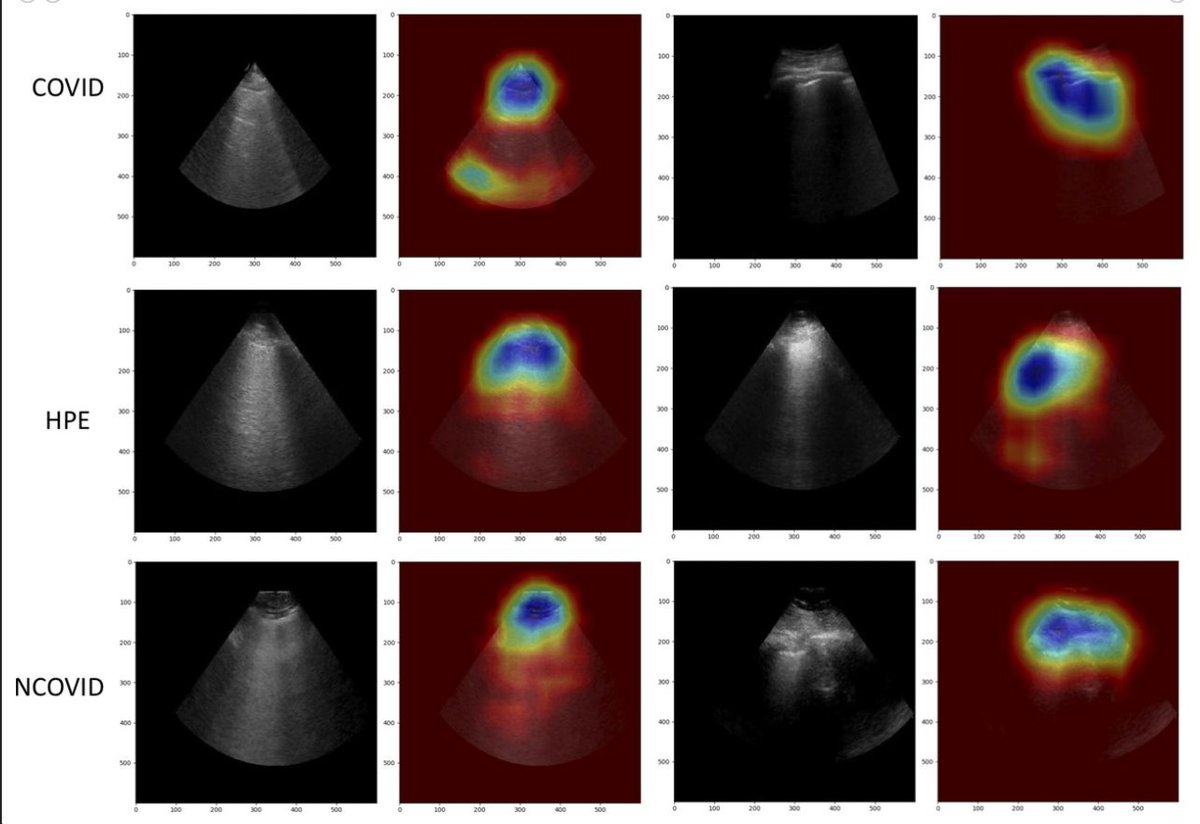 Robert Arntfield (@arntfield) on Twitter photo Could there be digital biomarkers in lung ultrasound images that cannot be seen by the human eye? Could this allow AI to make a bedside diagnosis > > a trained physician?
It is looking that way.
bmjopen.bmj.com/content/11/3/e…
#POCUS #AI
<a href="/SchulichMedDent/">Schulich WesternU</a> <a href="/LHSCCanada/">London Health Sciences Centre</a> @lawsonresearch Could there be digital biomarkers in lung ultrasound images that cannot be seen by the human eye? Could this allow AI to make a bedside diagnosis > > a trained physician?
It is looking that way.
bmjopen.bmj.com/content/11/3/e…
#POCUS #AI
<a href="/SchulichMedDent/">Schulich WesternU</a> <a href="/LHSCCanada/">London Health Sciences Centre</a> @lawsonresearch