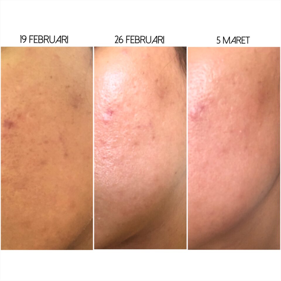 devina_ap's tweet photo. Aku udah pakai @datglowskin dari tanggal 19 Februari, bener-bener luar biasaaaaaaaaa perubahan yang terjadi pada tekstur dan PIH/PIE yang ada di kulit mukaku dalam 2 minggu lebih dikit ini. Sangat significant. #skincare #brightening #datglow https://t.co/7xMe8a7hvs