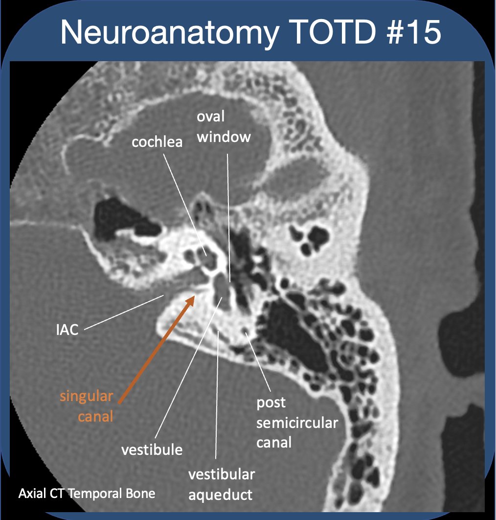 Neuroanatomy TOTD #15🧵 
The inner ear #tweetorial--it packs a large functional punch for its small size-strap in!
#meded #FOAMed #FOAMrad #medtwitter #medstudents #radiology #neurorad #HNrad #radres #neurology #ENT #temporalbone #neurosurgery #neuroanatomy #neuroanatomyTOTD
1/24