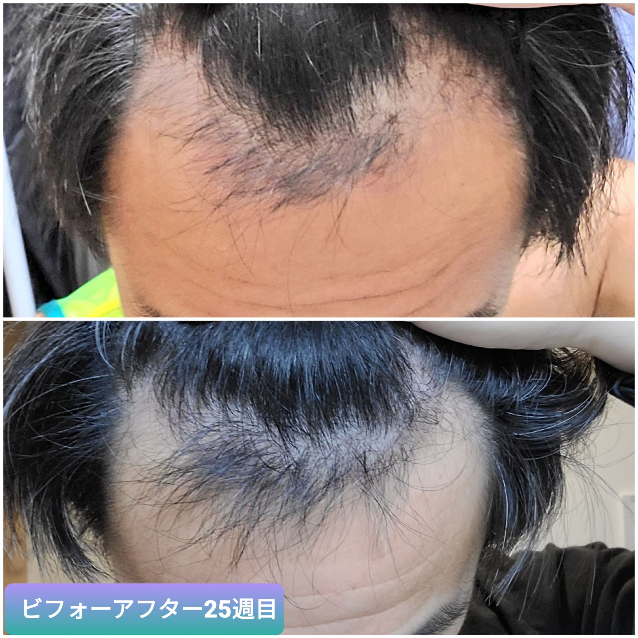 植毛 Fut 1511株 男 36歳 O7sgdnq05qa5qqb Twitter