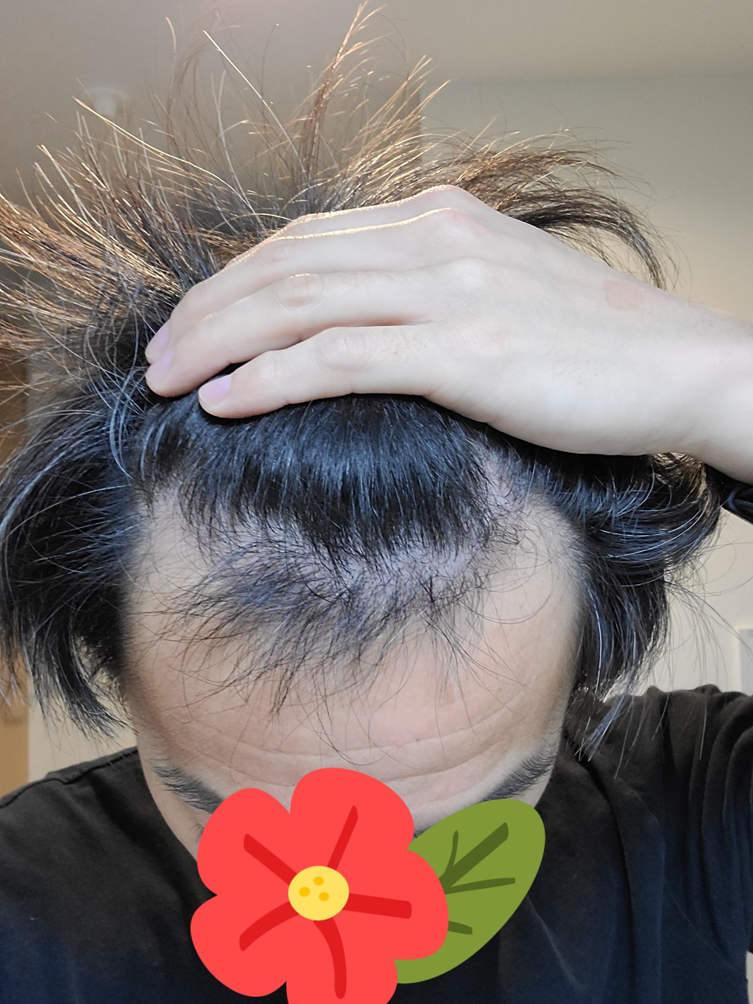 植毛 Fut 1511株 男 36歳 O7sgdnq05qa5qqb Twitter
