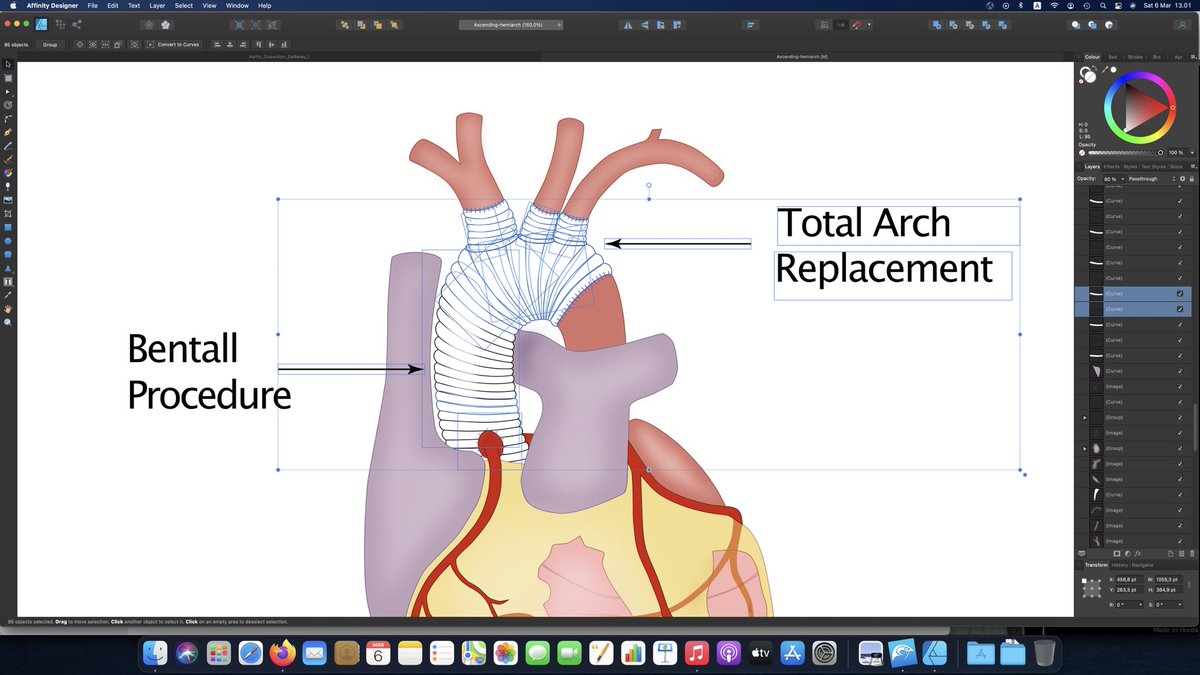 potret_bagus's tweet photo. My drawing for my next blog post.

#medicalillustration #illustrator #affinitydesigner #artist #bentall #bentallprocedure #totalarchreplacement #aorticsurgery #heartsurgery #bedahjantung #operasiaorta #bedahkardiovaskular #potretbagus https://t.co/pLtHbGYzLK