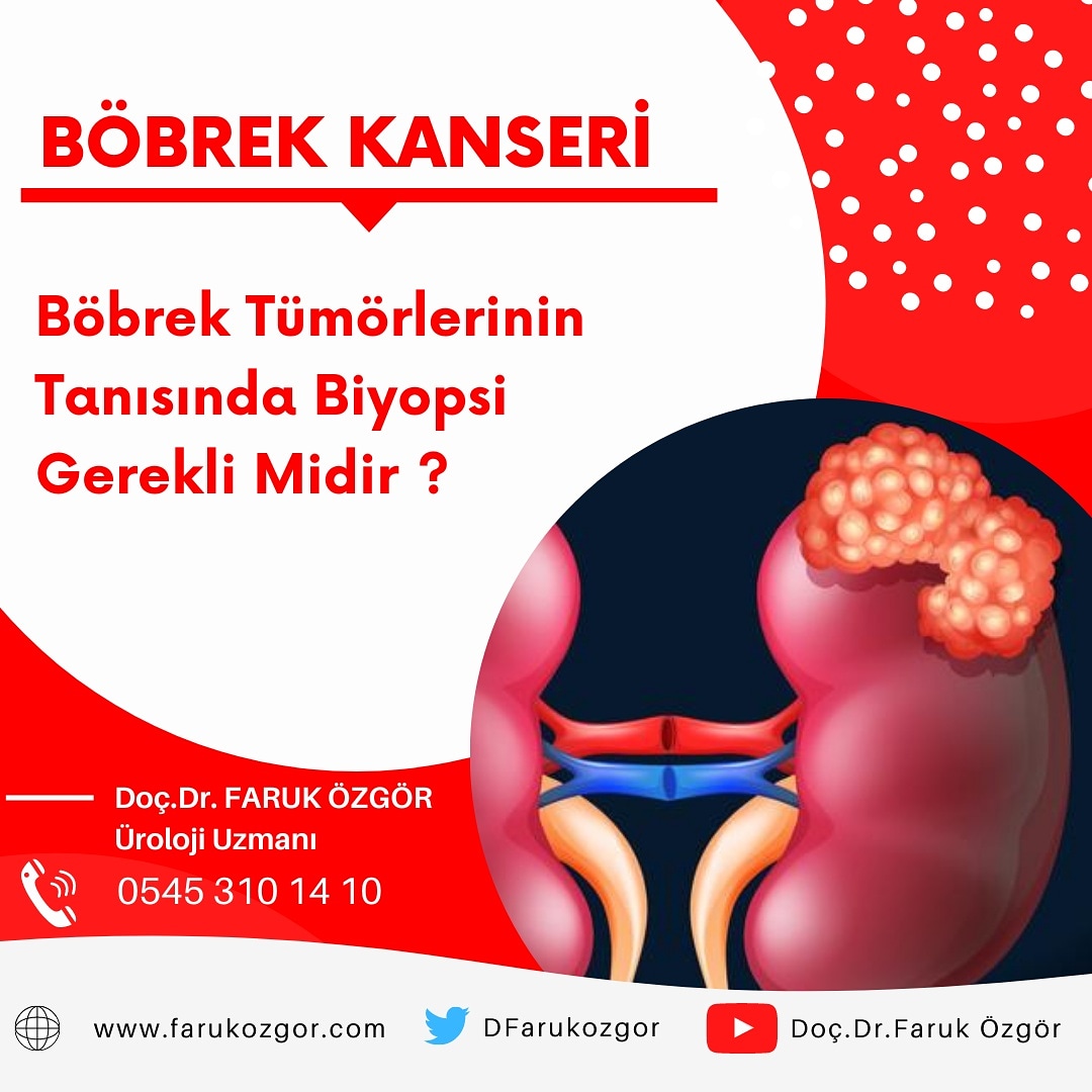 DFarukozgor's tweet photo. Kontrastlı BT ya da kontrastlı MR'da böbrekteki kitlenin kanser olarak değerlendirilmesi tedaviye başlamak için yeterlidir, özel durumlar hariç böbrek kanserleri tanı alırken biyopsiye ihtiyaç duyulmaz❗

Böbrek kanserlerinin en etkin tedavisi cerrahidir 📌

☎️ 0545 310 14 10 https://t.co/d1tMko0uED