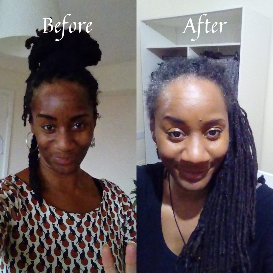 "Suffered with hyperpigmentation and discolouration for such a long time. Few weeks of using Eucalyptus Dermazeam noticed my skin had changed so much. My skin is vibrant, glowing and youthful, my lines are fading away and I'm beginning to get compliments on my skin and age!"