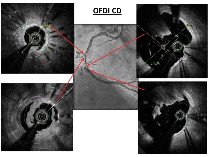 foroepic's tweet photo. #NewWeekendNewCase at https://t.co/6yHi5SuoEu 66yo🧓 STEMI 2y ago with primary PCI and 2DES at RCA. Discharge with AAS+prasu. Now #NSTEMI and stent thrombosis. Proximal underexpansion and distal malaposition (coronary aneurysm). What would U do?@foroic @AJuradoRoman @shci_sec https://t.co/tDcRadFhD5