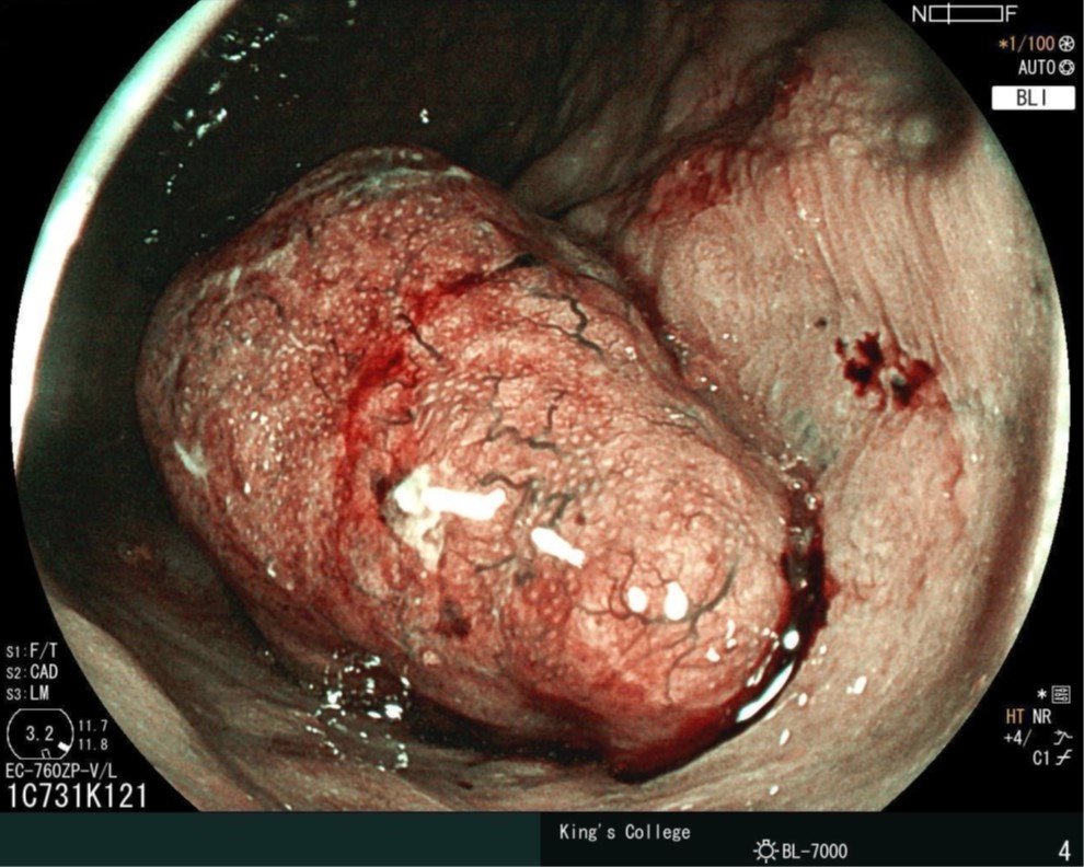 DrBuHayee's tweet photo. 1/3...
Asymptomatic man attending for bowel cancer screening colonoscopy (FIT>120) in the UK national programme. This lesion in the rectum https://t.co/wk4tWTnLGT