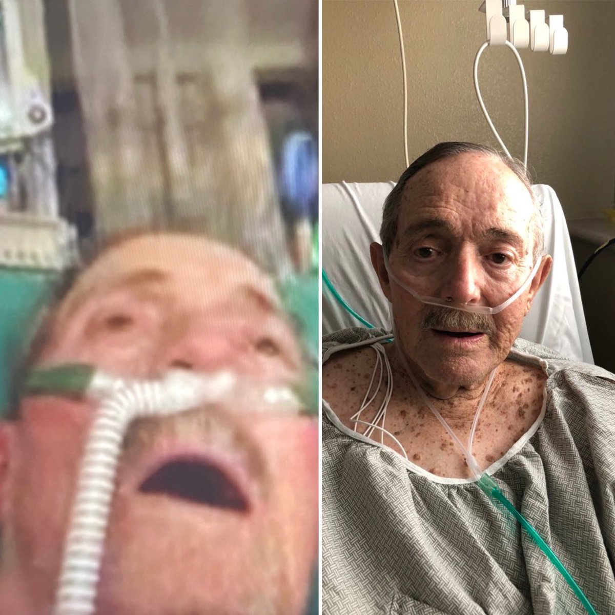 The pic on the left was my Dad 8 days ago when they told me he would likely die. I moved him the next day. The pic on the right was 5 days later. Transfer your loved one if something feels off.