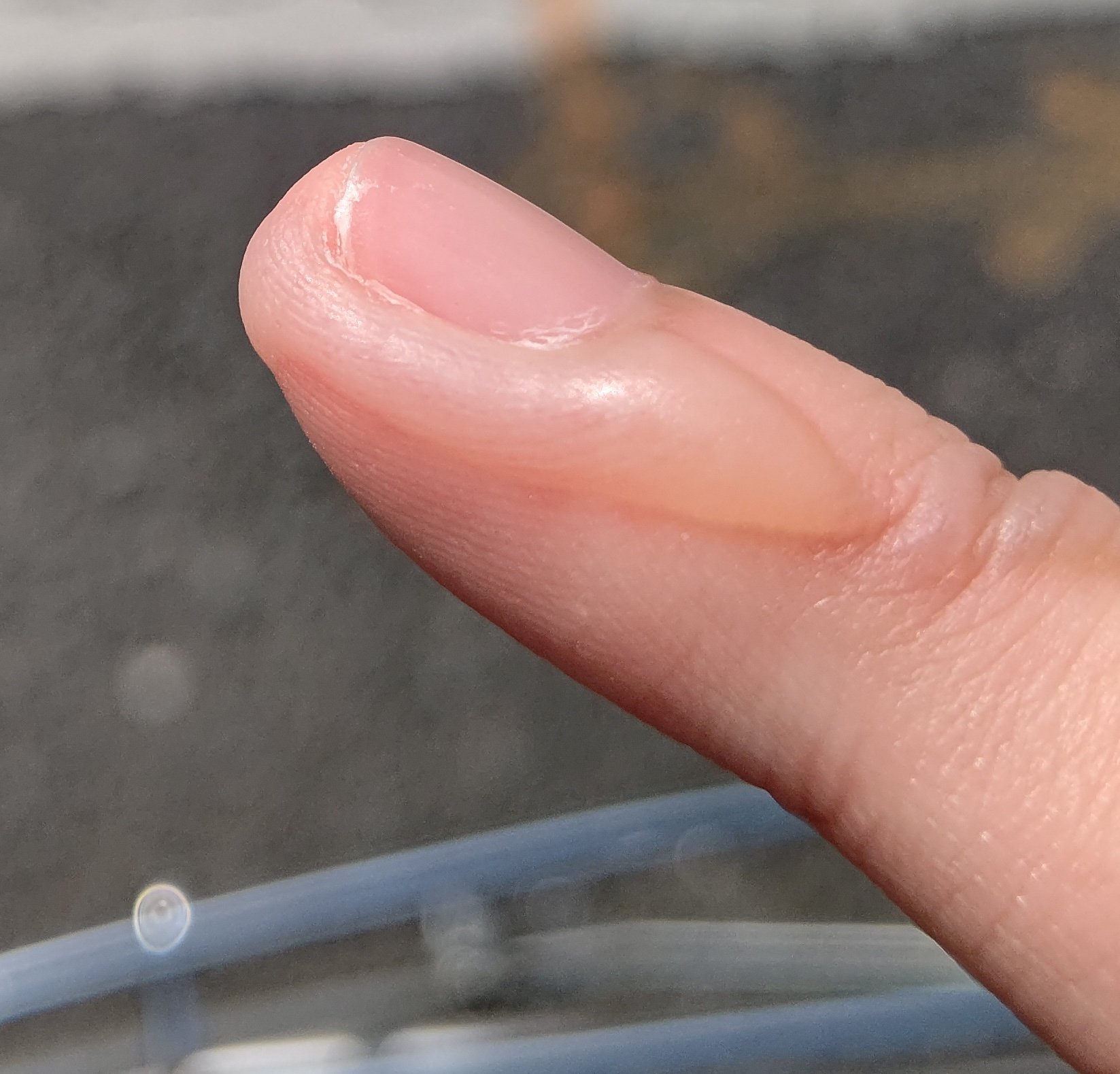 ライム ミンク 体育祭当日の朝に火傷しましたw ドッチボールとばれーして水ぶくれが成長を遂げました ドクドクしてる 命宿った T Co J9ewwgy7wy Twitter