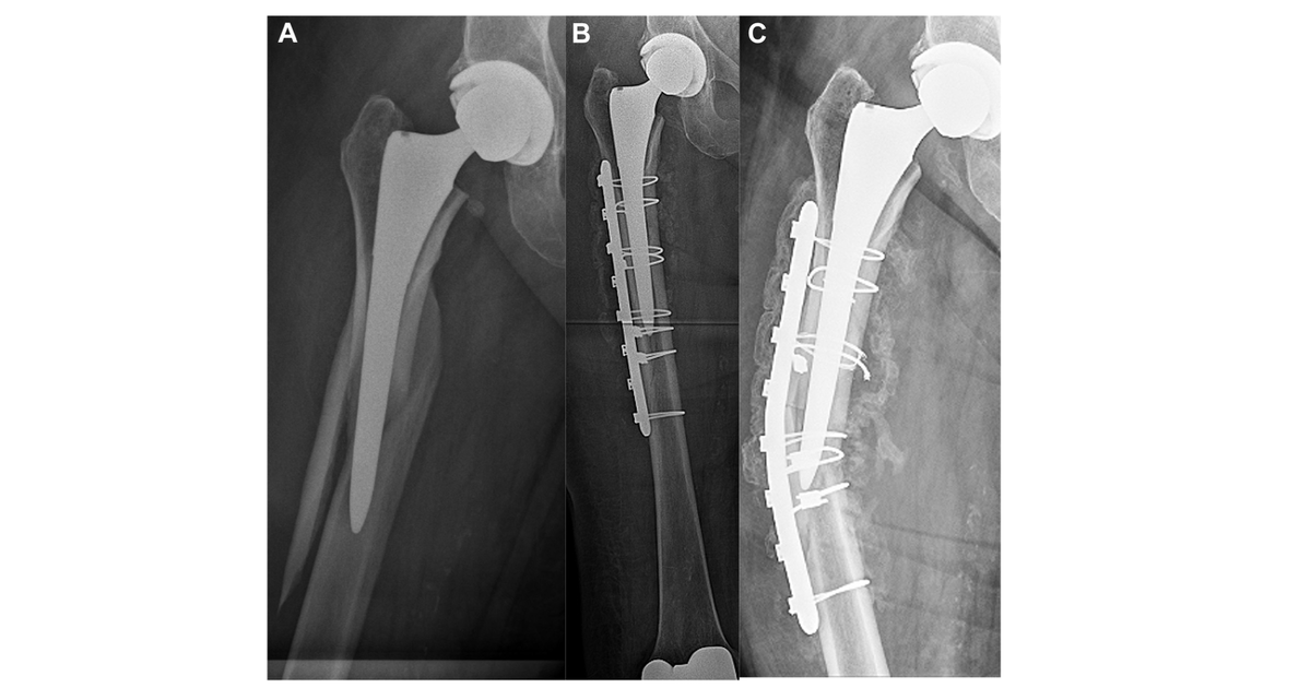 RobZondervan's tweet photo. #FractureFriday Analysis of failure modes based on #fracture type in periprosthetic femur fractures can help direct future fixation techniques. @JArthroplasty 
https://t.co/mZ9euY9utY
@ORSsociety @isfrfractures #TweetTheTib https://t.co/ll6PK6BWcb