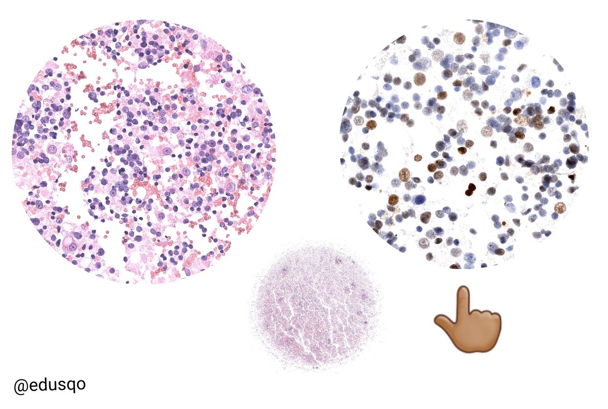 edusqo's tweet photo. Lymph node metastasis (prostatic adenocarcinoma). Not easy while ROSEing w #DiffQuik 👀... lymphoproliferative disorder?
I opted this time to combine conventional smears and cytospin.
NKX3.1 nuclear stain was nice and helped with the diagnosis.
#IHCPath #FNAFriday #CytoPath https://t.co/mhu4tzhqkt