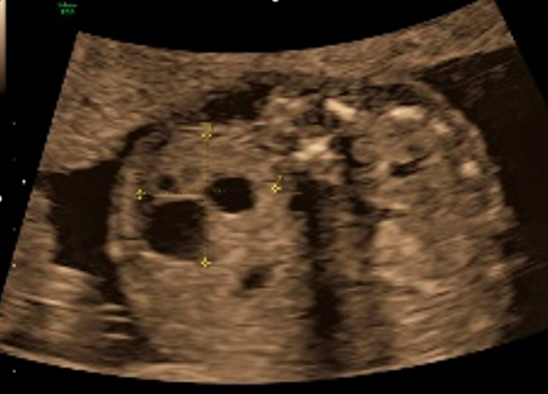 Test your knowledge with the weekly #ISUOGEducation quiz:

What is the diagnosis in the ultrasound image?

a. Abdominal cyst
b. Double bubble
c. Ovarian cyst
d. Renal cystic dysplasia

The #ISUOG Basic Training curriculum is available online bit.ly/3tyoRwX