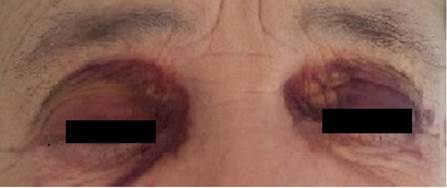 SemiologiaM's tweet photo. Paciente de 68 años con antecedentes de túnel carpiano operado. Presenta disnea de esfuerzo progresiva y ortopnea. Refiere desde hace unos años la aparición de hematomas periorbitarios que aparecen y desaparecen. Llama la atención su lengua al explorarla. ¿Sospecha diagnóstica? https://t.co/kCcSrs3oh4